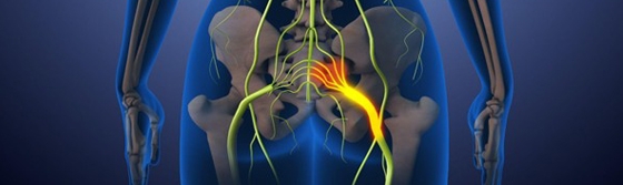 Sciatica: From Symptoms to Surgical Relief