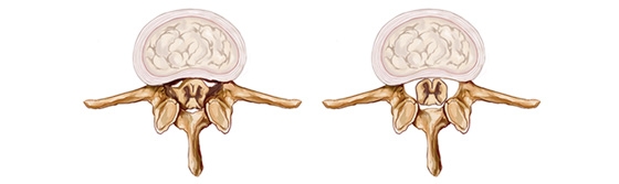 Top Signs of Spinal Stenosis