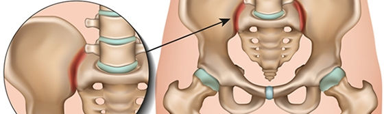 Understanding Sacroiliac (SI) Joint Dysfunction: The Overlooked Cause of Low Back Pain