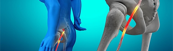 When Leg Pain Isn't a Leg Problem: How Spine Conditions Cause Sciatica and Nerve Pain