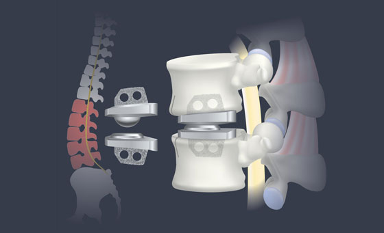 Artificial Disc Replacement Surgery