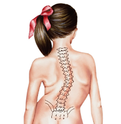 Scoliosis Surgery: The Complete Guide