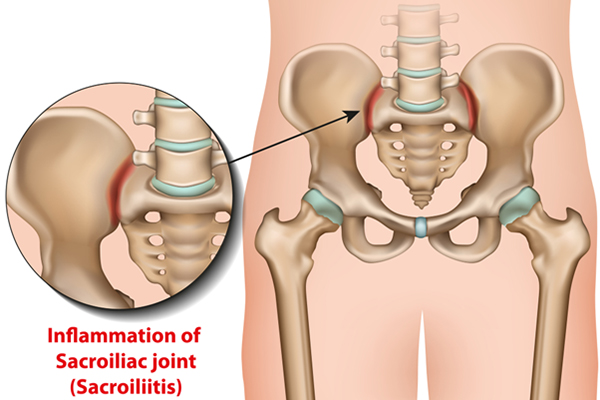 Understanding Sacroiliac (SI) Joint Dysfunction: The Overlooked Cause of Low Back Pain