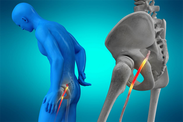 When Leg Pain Isn't a Leg Problem: How Spine Conditions Cause Sciatica and Nerve Pain