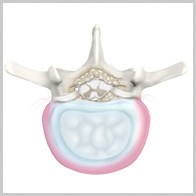  Degenerative Disc Disease 