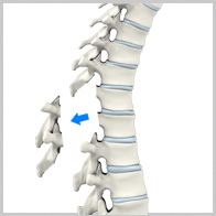 Laminectomy Surgery