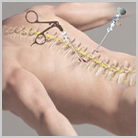 Minimally Invasive Spine Surgery