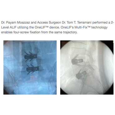 Dr. Payam Moazzaz featured in NovApproach Spine publication as first to use new “head-gripping” technology for the OneLIF™ device in spine surgery. 