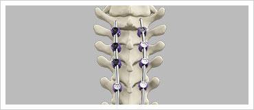 Scoliosis Surgery