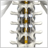 Spinal Fusion Surgery